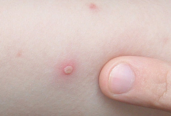 Chickenpox (Varicella disease) blister.GNU Free Doc License. Zeimusu
