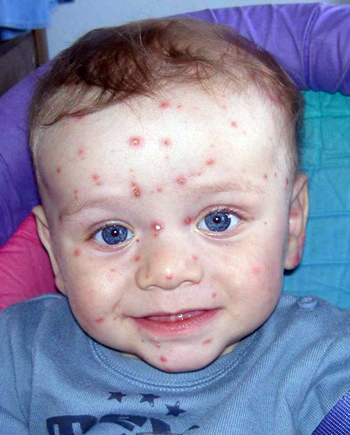 Chickenpox. Thomas Netsch . Bild-PD. Niño con lesiones de varicela en la cara